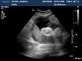 Jachin the alien baby