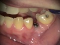 Implant Microsurgery: Narrow Diameter Implants