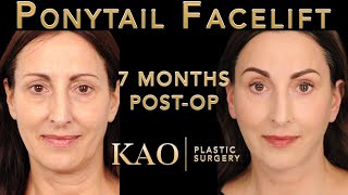 Art of The Facelift - Ponytail Facelift™ Before And After - Skin Resurfacing - KAO Plastic Surgery
