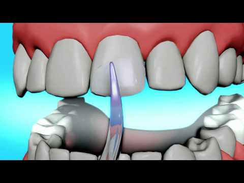 BONDING - ACE Dental Education- Dental Bonding: http://www.acedentalresource.com/dental-procedures/cosmetic-dentistry/teeth-bonding/ Tooth bonding is the application o...