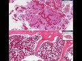 Pathology - Paget disease of bone
