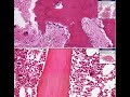 Histopathology Bone--Paget disease Histopathology Bone--Paget disease
