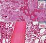 Histopathology Bone--Paget disease