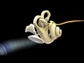 Myringotomy - Ear Tubes for Fluid, Infection