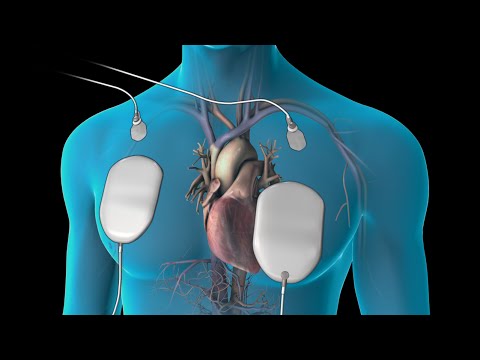 how to perform dc cardioversion