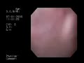 Endoscopía