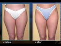SmartLipo, Liposuction SmartLipo, Liposuction