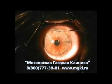 Видео Лазерная коррекция зрения при астигматизме