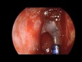 Endoscopic Sinus Surgery - Frontal Polypectomy Endoscopic Sinus Surgery - Frontal Polypectomy