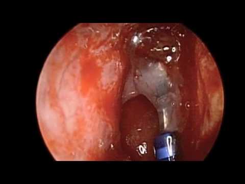 how to drain frontal sinus