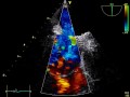 Multiple Atrial Septal Defects