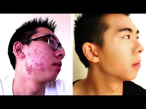 how to cover up a acne