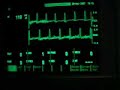 stress induced sinustachycardia