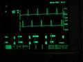stress induced sinustachycardia