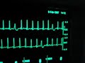 intensive care ecg with extrasystoles