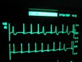 intensive care ecg with extrasystoles intensive care ecg with extrasystoles
