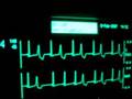 intensive care ecg with extrasystoles