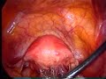 severe-endometriosis-2-of-7.html