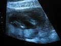 17w0d ultrasound #3