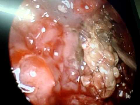 how to kill sinus fungus