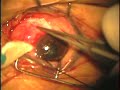 Pterygium+surgery