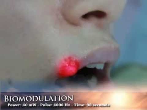 how to drain a mouth ulcer