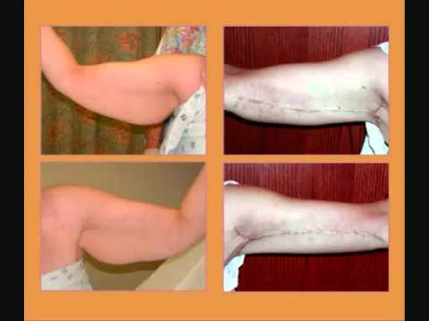 how to qualify for skin removal surgery