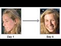 Get Rid Of Acne For Good Get Rid Of Acne For Good
