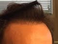 Hair transplant dallas hairline dallas closeup