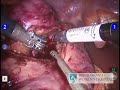 complex-robotic-partial-nephrectomy.html