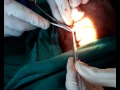 Sebaceous cyst neck excision.wmv