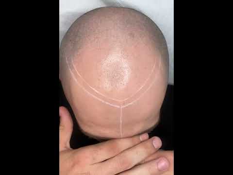 Micropigmentare Scalp 3 - 2