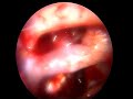Brain Tumor removal