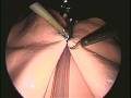 laparoscopic suturing techniques, suture assistant, laparTy, ethicon