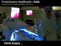 Hernia treatment in India from the well trained surgeons. Umbilical hernia