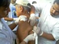 Dr. Fritz removes carbuncle from man's back