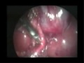 Laparoscopic Cholecystectomy in a patient with Situs Inversus Totalis(S.I.T)