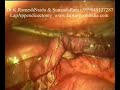 Laparoscopy Appendicectomy Video -3 (Keyhole / Lap Appendix) Laparoscopy Appendicectomy Video -3 (Keyhole / Lap Appendix)