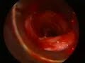 Endoscopic diilation of tracheal stenosis