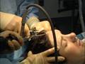 Brow-Lift