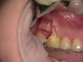 Root Coverage with Lateral Sliding Flap