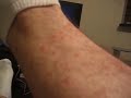 Flea Bites Flea Bites