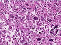 Medical School Pathology, Chapter 7d: Neoplasia