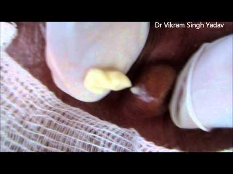 how to drain sebaceous cyst behind ear