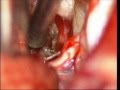 Brain stem tumor- pontine glioma-microsurgery-dr suresh dugani/HUBLI/KARNATAK/INDIA