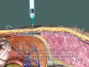 Thoracotomy (improper procedure)