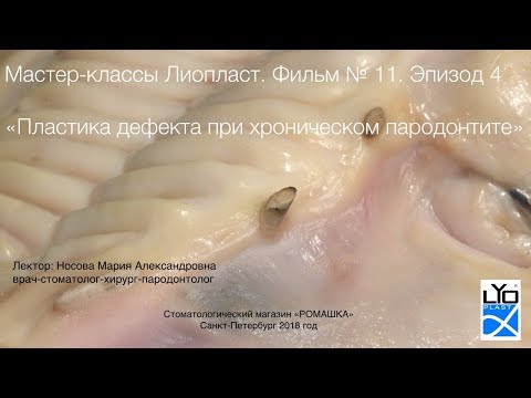 Мастер-класс Лиопласт 11.4 Трехмерная аугментация альвеоляра при пародонтите