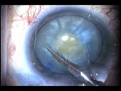 how to get rid dilated pupils