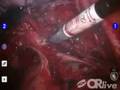 Strategies for Managing Endometriosis, Prior Pelvic Surgery