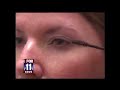 Lumigan Eyelash Extension  Glaucoma Bimatoprost